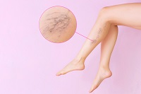 Female legs with varicose veins. Concept of human health and disease. Vascular diseases, problems of varicose veins. Enlarged image of blood vessels needs compression sock