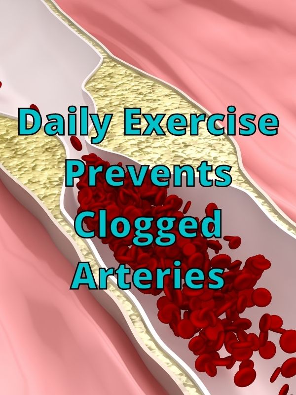 Daily Exercise Prevents Clogged Arteries