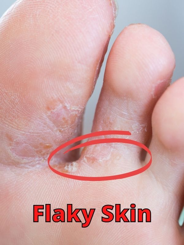 Flaky Skin Athlete's Foot