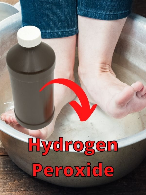 Hydrogen Peroxide Athlete's Foot