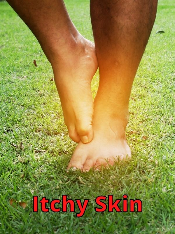 Itchy Skin athlete's foot
