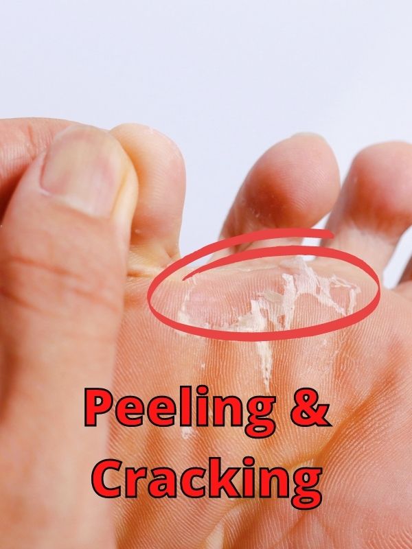 Peeling & Cracking Athlete's Foot