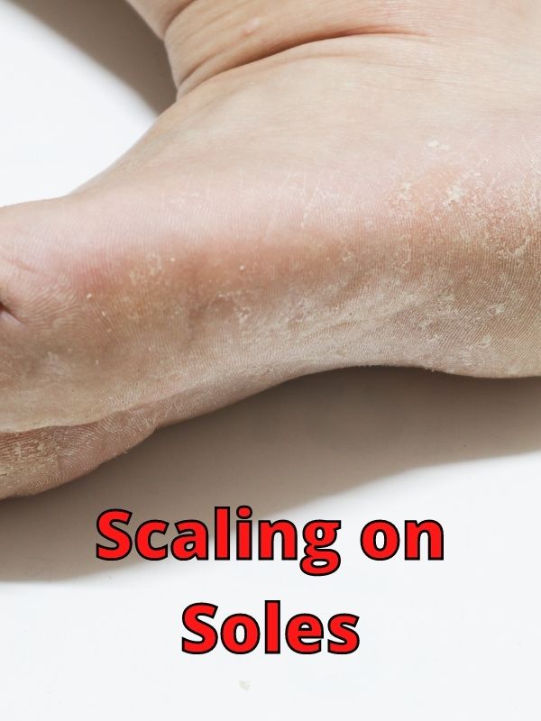 Scaling on Soles Athlete's Foot (1)